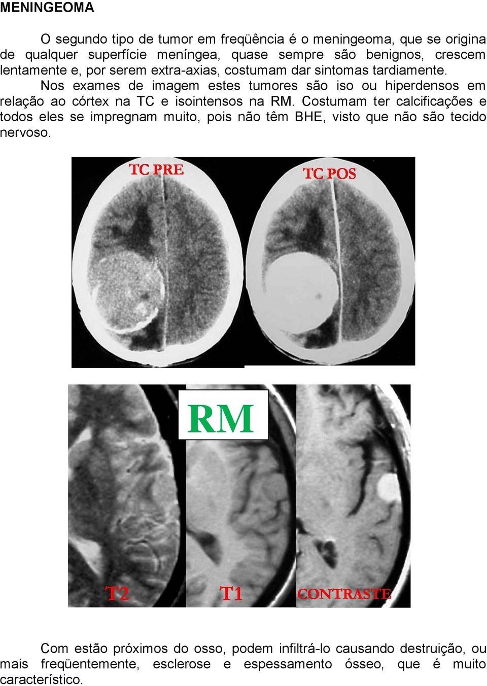 Nos exames de imagem estes tumores são iso ou hiperdensos em relação ao córtex na TC e isointensos na RM.