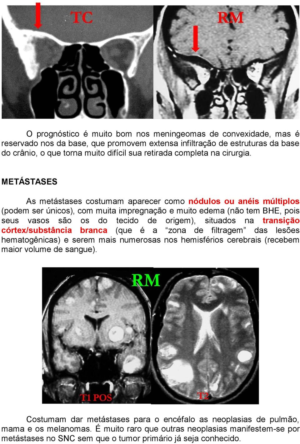 METÁSTASES As metástases costumam aparecer como nódulos ou anéis múltiplos (podem ser únicos), com muita impregnação e muito edema (não tem BHE, pois seus vasos são os do tecido de origem),