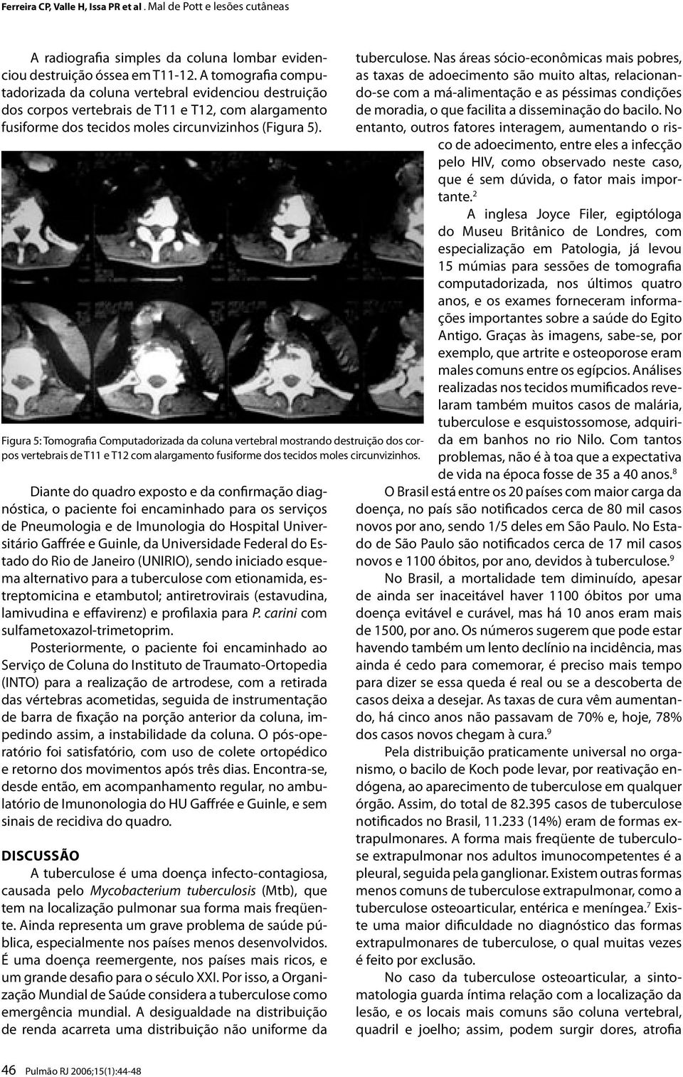 Figura 5: Tomografia Computadorizada da coluna vertebral mostrando destruição dos corpos vertebrais de T11 e T12 com alargamento fusiforme dos tecidos moles circunvizinhos.