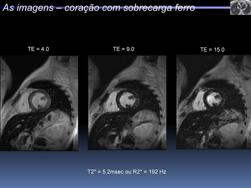 0 TE = 9.0 TE = 15.