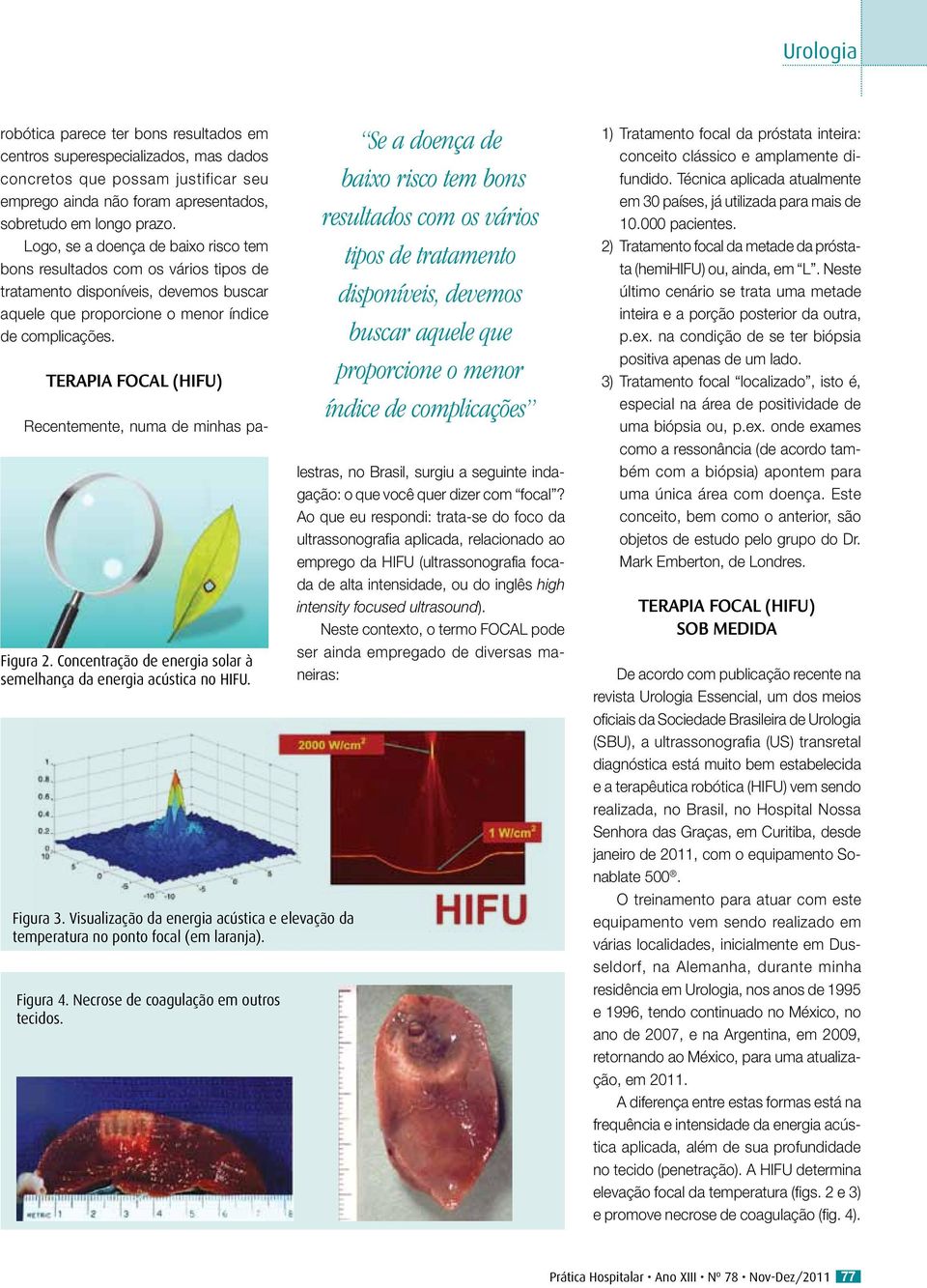 Concentração de energia solar à semelhança da energia acústica no HIFU. Figura 3. Visualização da energia acústica e elevação da temperatura no ponto focal (em laranja). Figura 4.