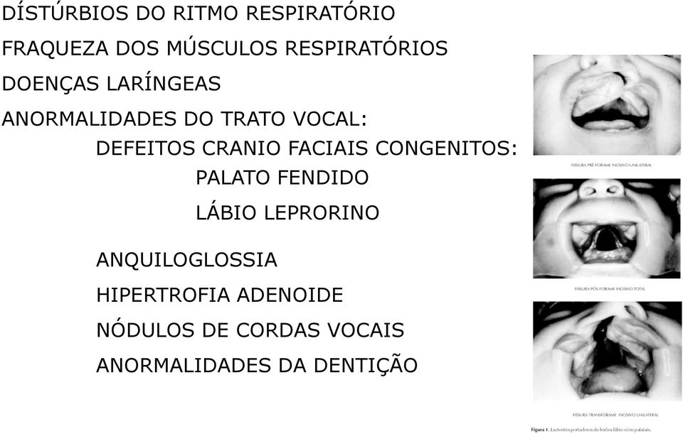 DEFEITOS CRANIO FACIAIS CONGENITOS: PALATO FENDIDO LÁBIO LEPRORINO