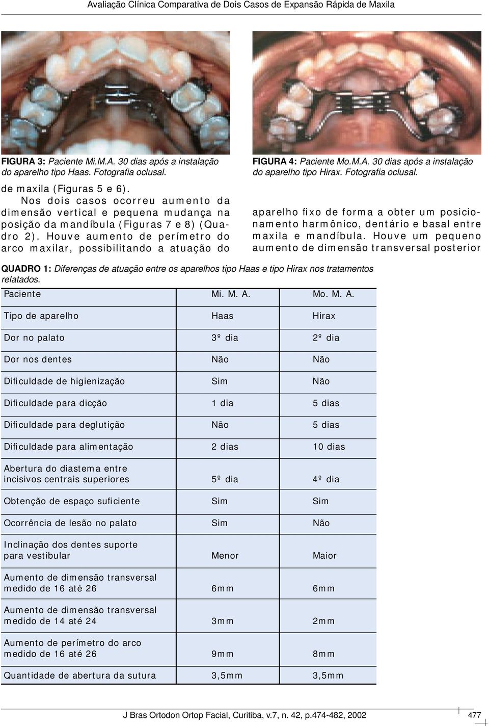Houve aumento de perímetro do arco maxilar, possibilitando a atuação do FIGURA 4: Paciente Mo.M.A. 30 dias após a instalação do aparelho tipo Hirax. Fotografi a oclusal.