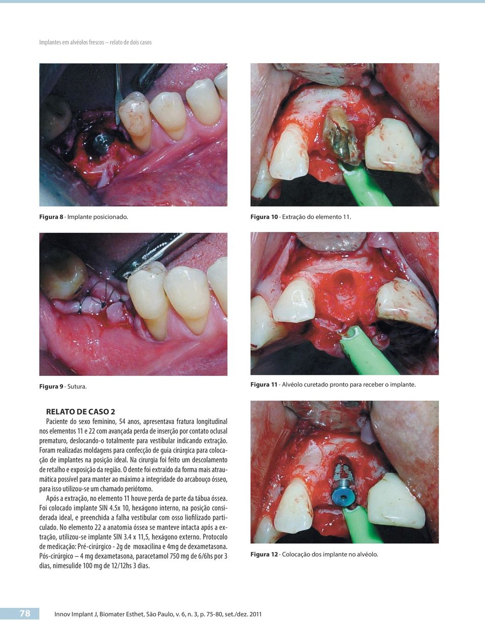 vestibular indicando extração. Foram realizadas moldagens para confecção de guia cirúrgica para colocação de implantes na posição ideal.