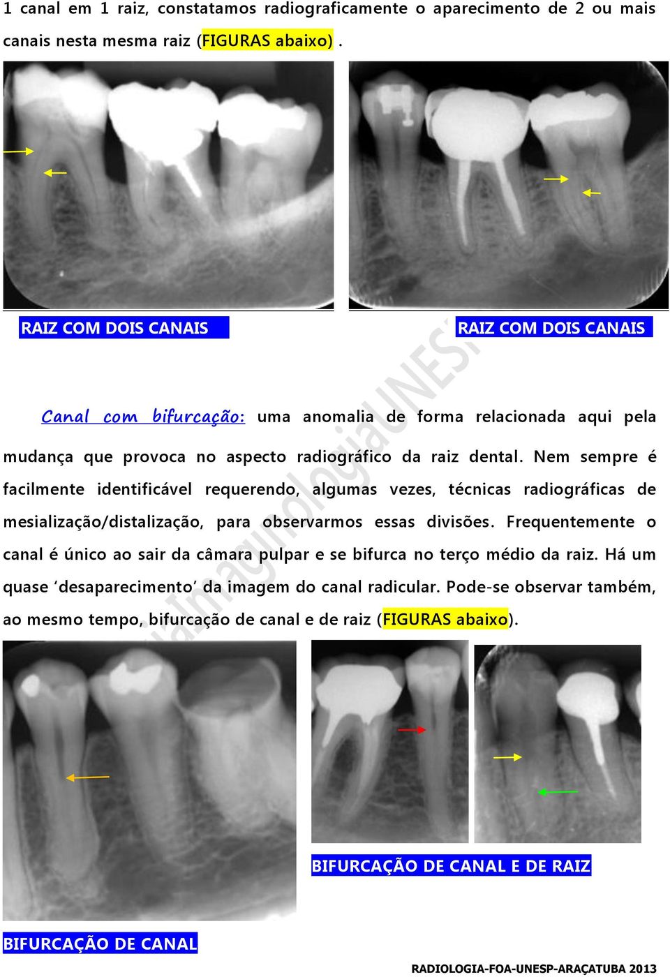 Nem sempre é facilmente identificável requerendo, algumas vezes, técnicas radiográficas de mesialização/distalização, para observarmos essas divisões.