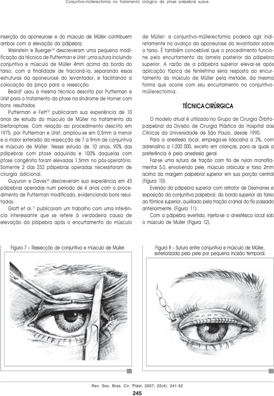 tracioná-la, separando essas estruturas da aponeurose do levantador, e facilitando a colocação da pinça para a ressecção.