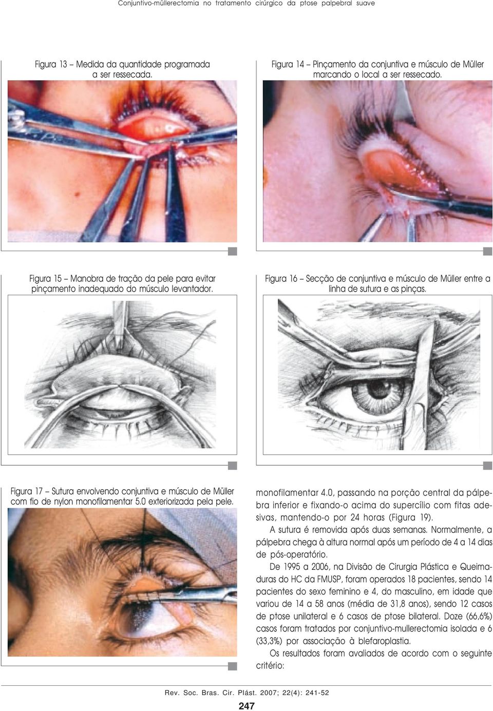 Figura 16 Secção de conjuntiva e músculo de Müller entre a linha de sutura e as pinças. Figura 17 Sutura envolvendo conjuntiva e músculo de Müller com fio de nylon monofilamentar 5.