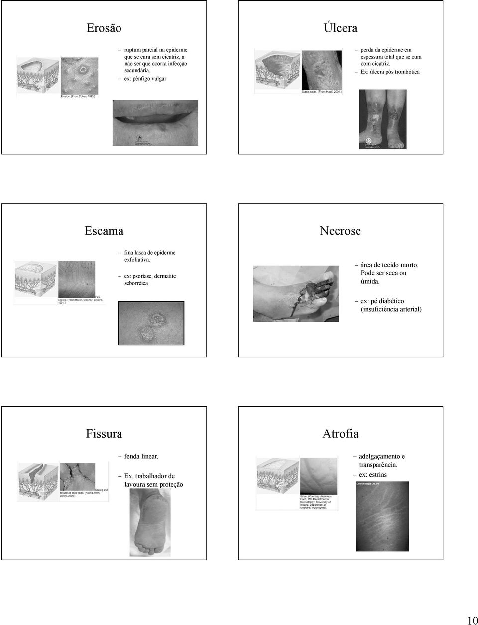 Ex: úlcera pós trombótica Escama Necrose fina lasca de epiderme exfoliativa.