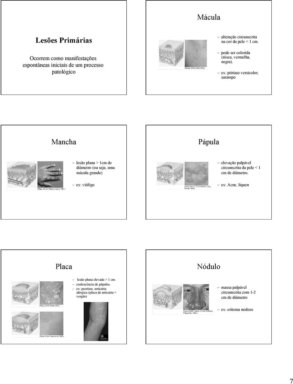 ex: ptiríase versicolor, sarampo Mancha Pápula lesão plana > 1cm de diâmetro (ou seja, uma mácula grande) ex: vitiligo elevação palpável