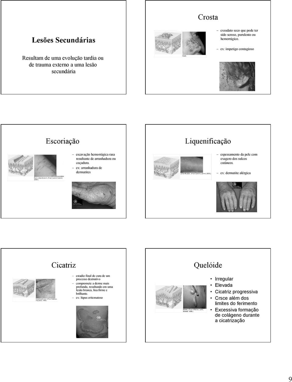 ex: arranhadura de dermatites Liquenificação espessamento da pele com exagero dos sulcos cutâneos.