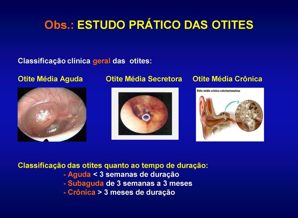 Classificação das otites quanto ao tempo de duração: - Aguda < 3