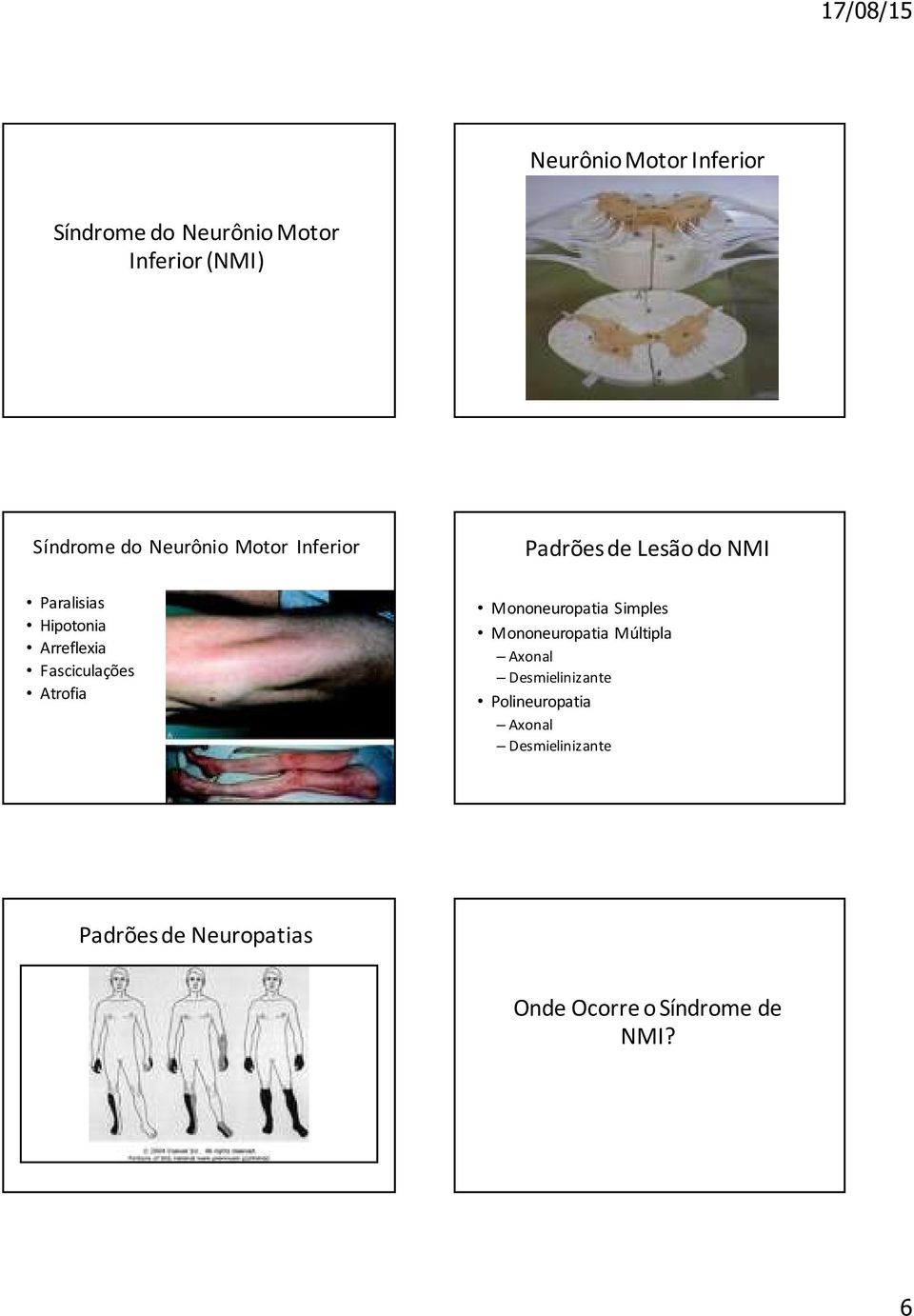 Fasciculações Atrofia Mononeuropatia Simples Mononeuropatia Múltipla Axonal