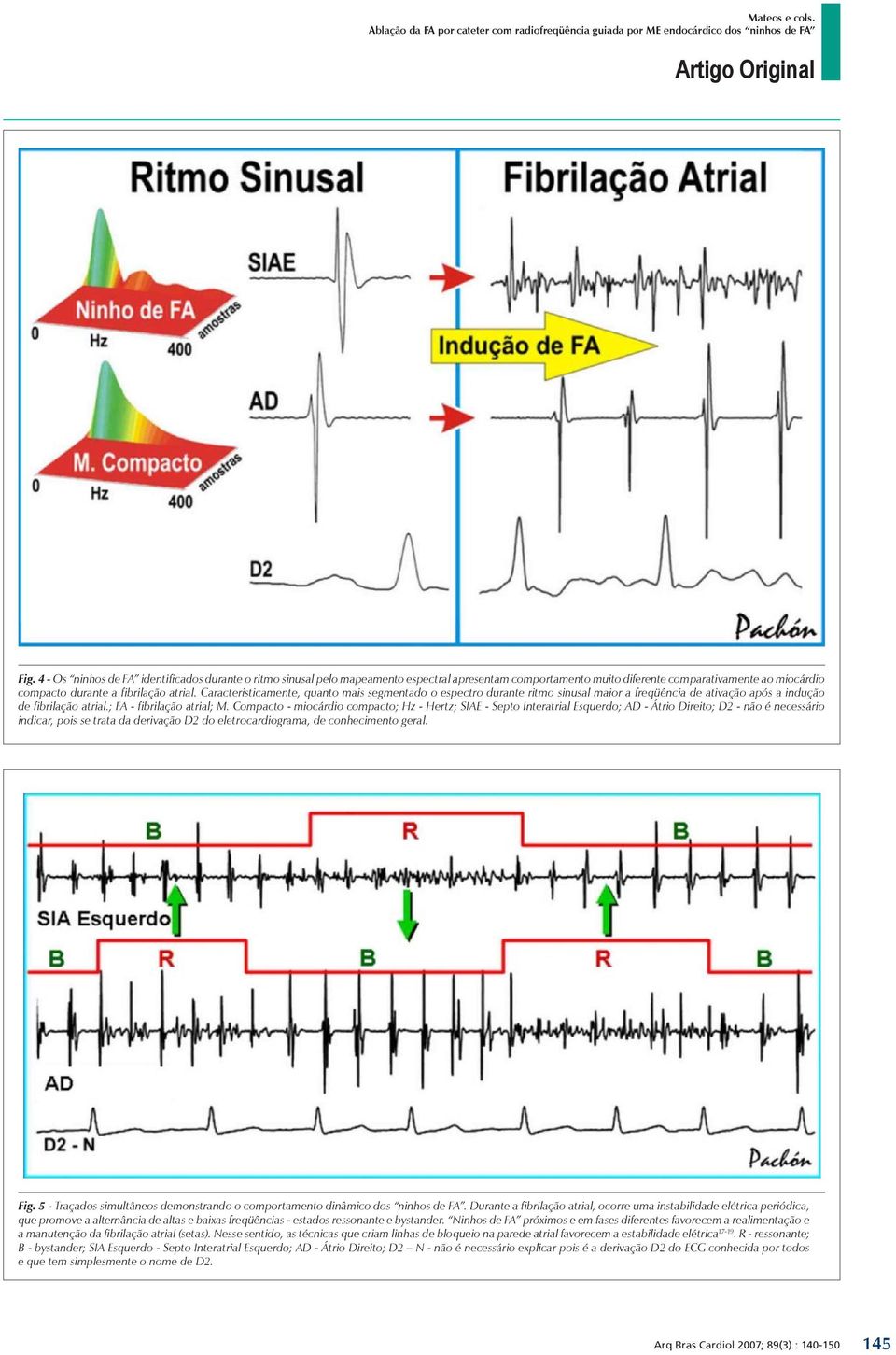 Compacto - miocárdio compacto; Hz - Hertz; SIAE - Septo Interatrial Esquerdo; AD - Átrio Direito; D2 - não é necessário indicar, pois se trata da derivação D2 do eletrocardiograma, de conhecimento