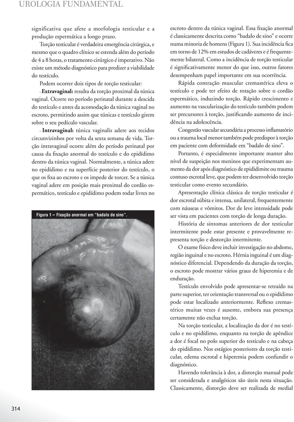 Não existe um método diagnóstico para predizer a viabilidade do testículo. Podem ocorrer dois tipos de torção testicular: - Extravaginal: resulta da torção proximal da túnica vaginal.