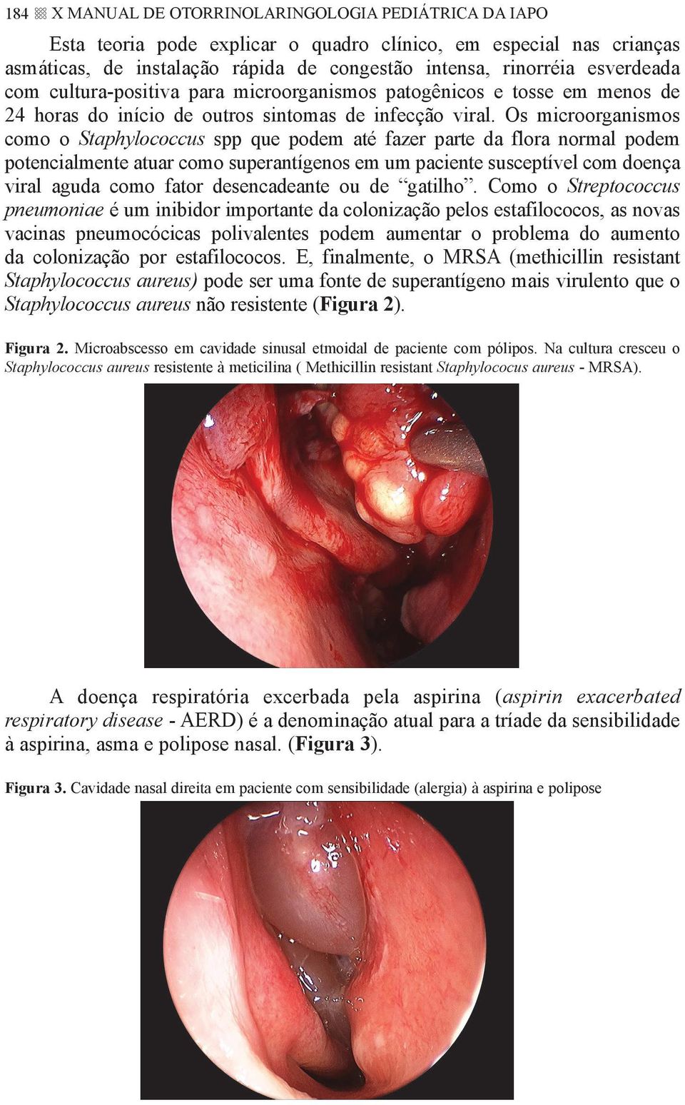 Os microorganismos como o Staphylococcus spp que podem até fazer parte da flora normal podem potencialmente atuar como superantígenos em um paciente susceptível com doença viral aguda como fator