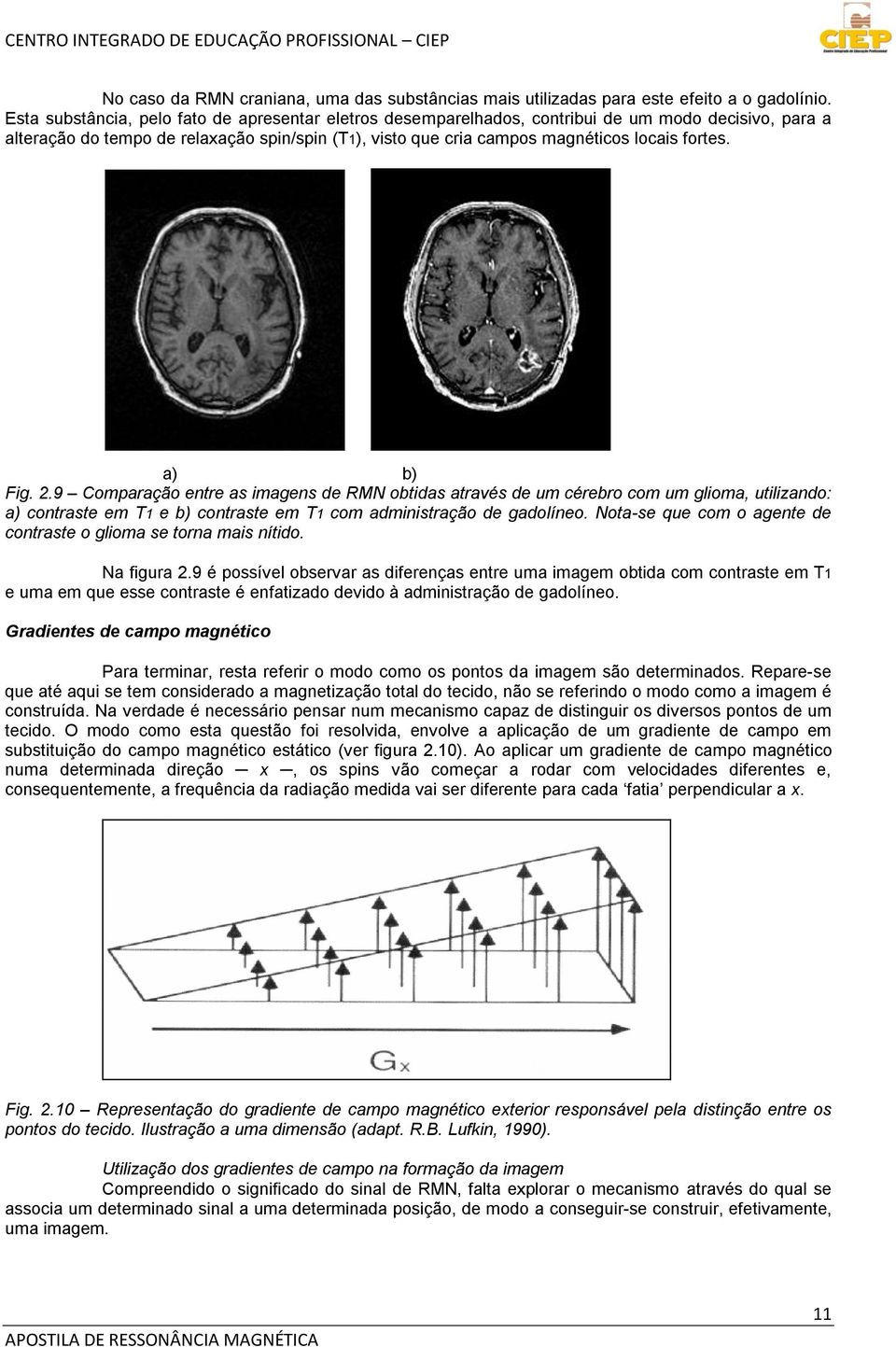 a) b) Fig. 2.9 Comparação entre as imagens de RMN obtidas através de um cérebro com um glioma, utilizando: a) contraste em T1 e b) contraste em T1 com administração de gadolíneo.