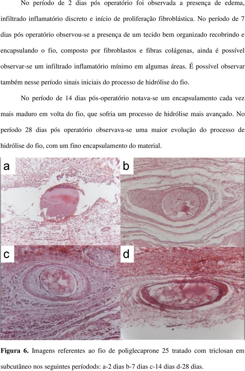 infiltrado inflamatório mínimo em algumas áreas. É possível observar também nesse período sinais iniciais do processo de hidrólise do fio.