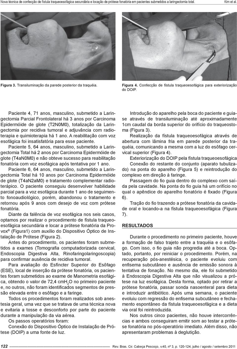 com radioterapia e quimioterapia há 1 ano. A reabilitação com voz esofágica foi insatisfatória para esse paciente.