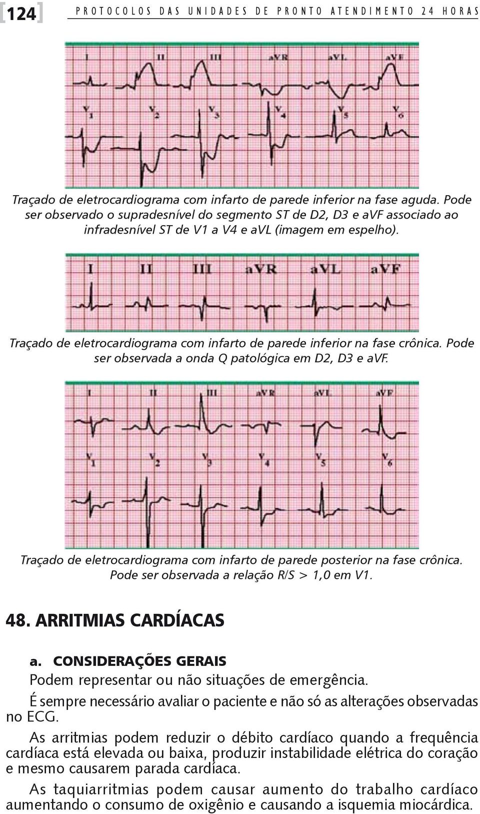 Traçado de eletrocardiograma com infarto de parede inferior na fase crônica. Pode ser observada a onda Q patológica em D2, D3 e avf.