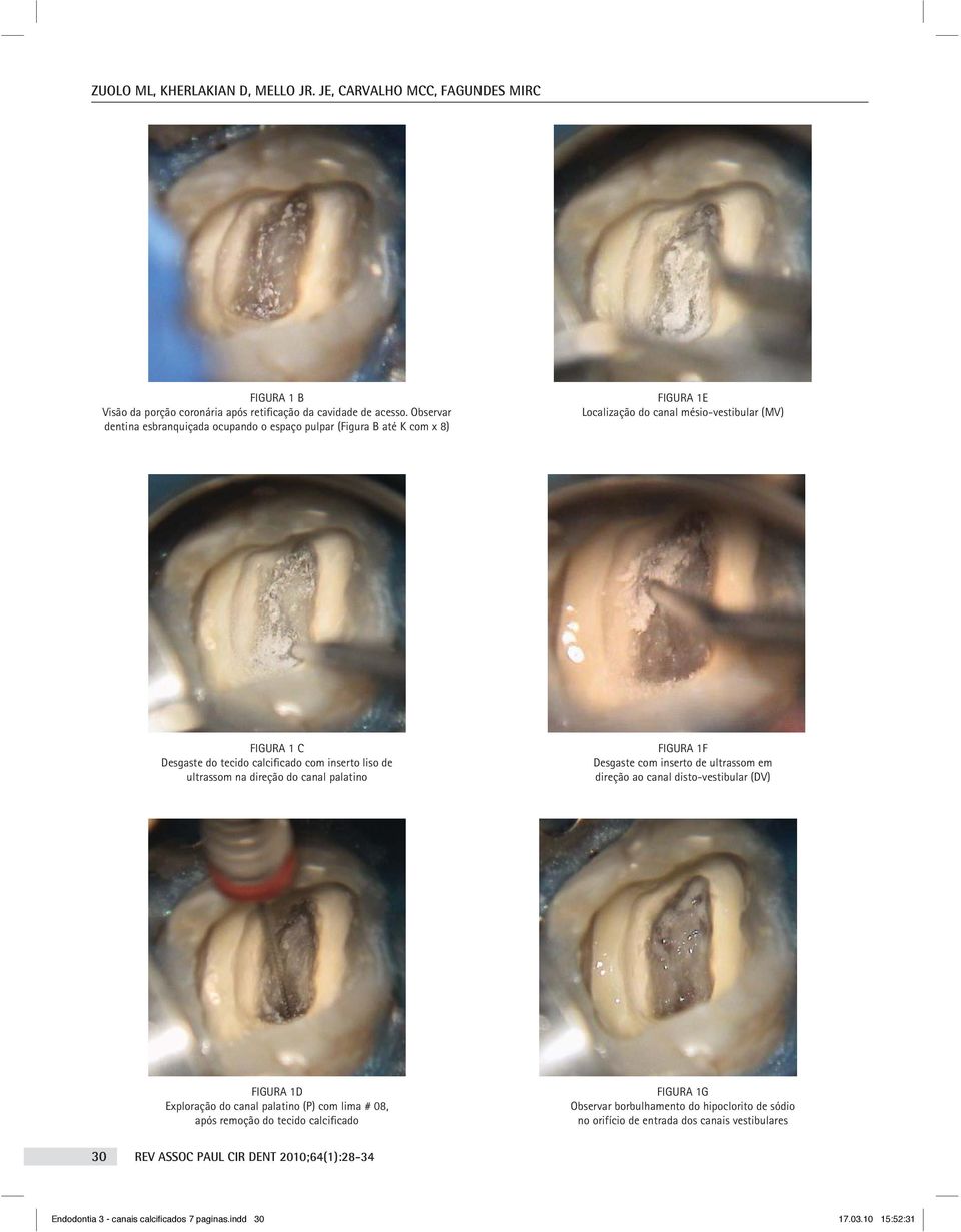 de ultrassom na direção do canal palatino FIGURA 1F Desgaste com inserto de ultrassom em direção ao canal disto-vestibular (DV) FIGURA 1D Exploração do canal palatino (P) com lima # 08, após