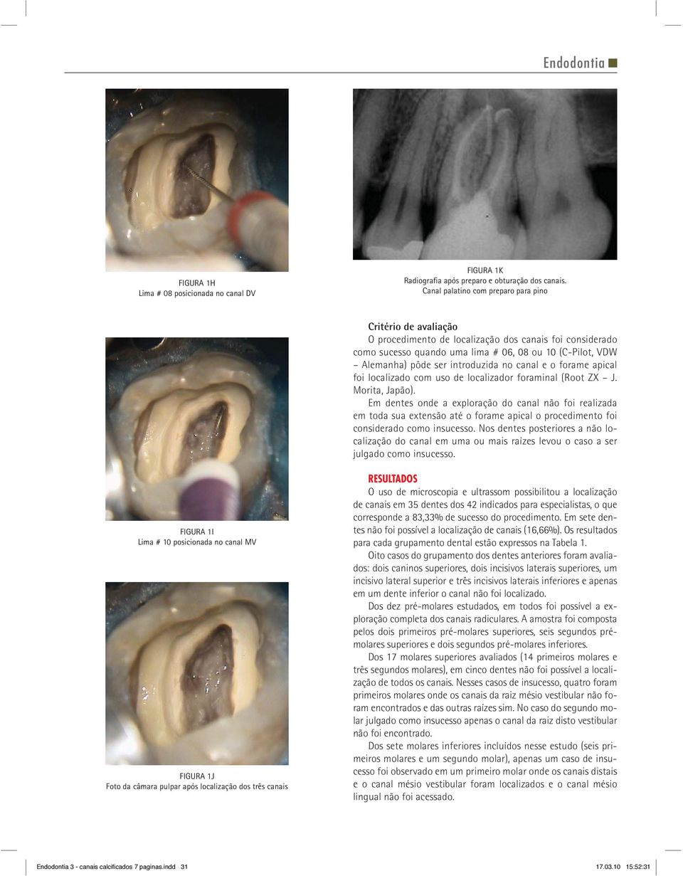 introduzida no canal e o forame apical foi localizado com uso de localizador foraminal (Root ZX J. Morita, Japão).