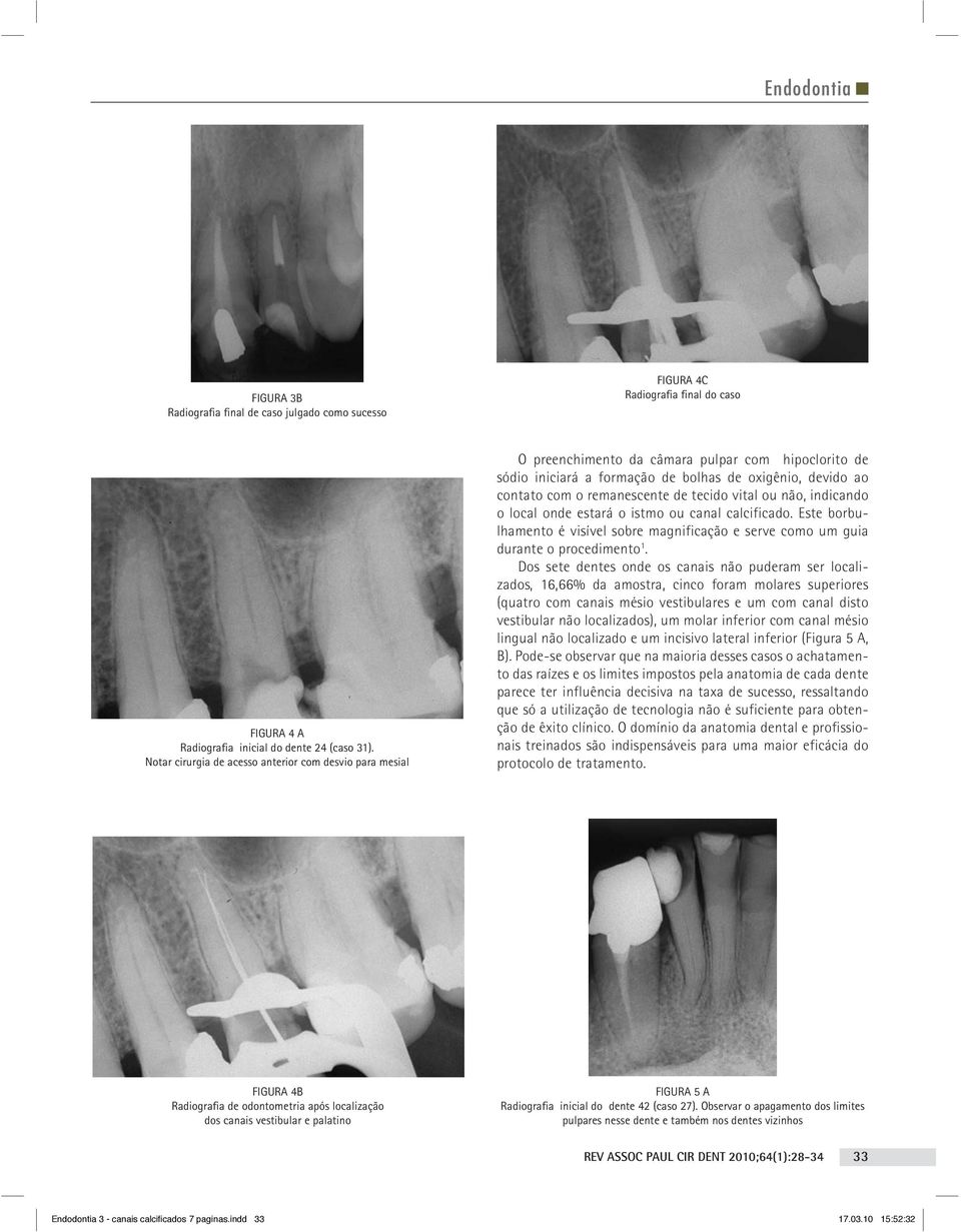 tecido vital ou não, indicando o local onde estará o istmo ou canal calcificado. Este borbulhamento é visível sobre magnificação e serve como um guia durante o procedimento 1.