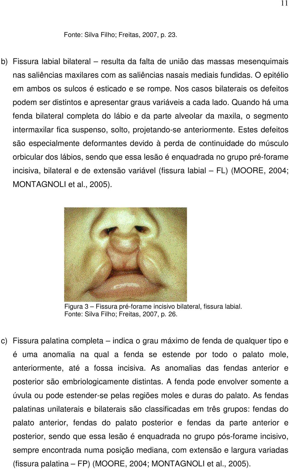 Quando há uma fenda bilateral completa do lábio e da parte alveolar da maxila, o segmento intermaxilar fica suspenso, solto, projetando-se anteriormente.