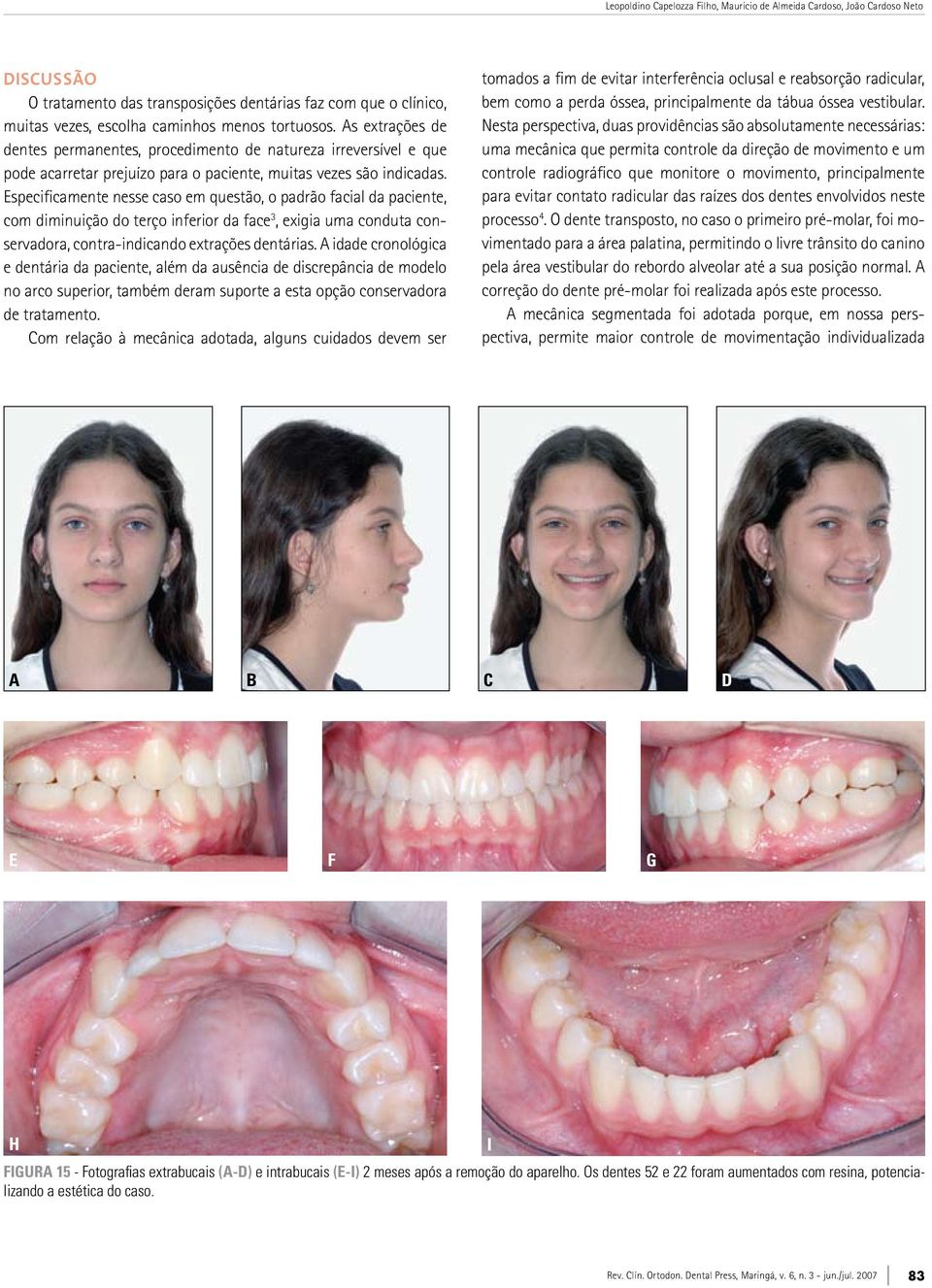 Especificamente nesse caso em questão, o padrão facial da paciente, com diminuição do terço inferior da face 3, exigia uma conduta conservadora, contra-indicando extrações dentárias.