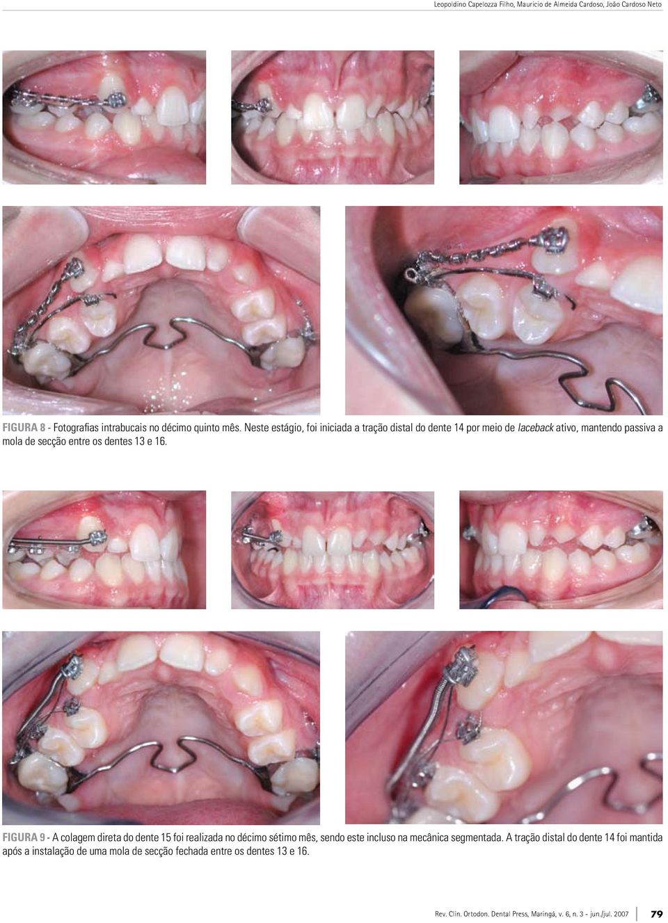 entre os dentes 13 e 16.