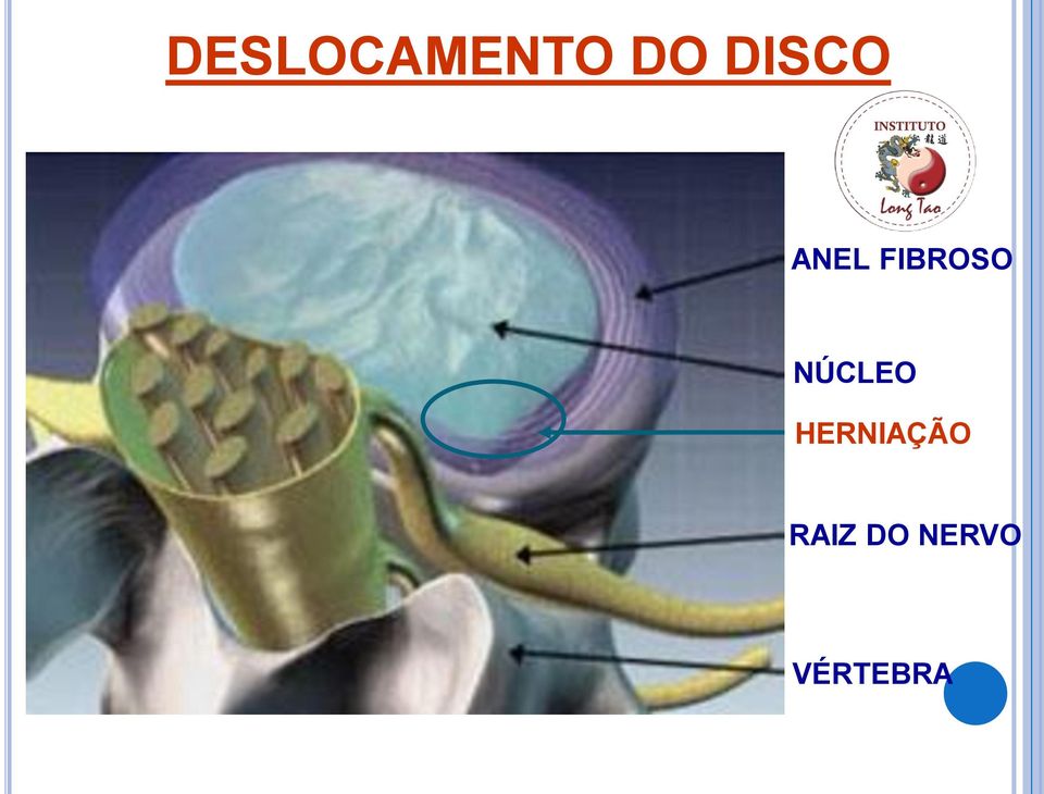 NÚCLEO HERNIAÇÃO