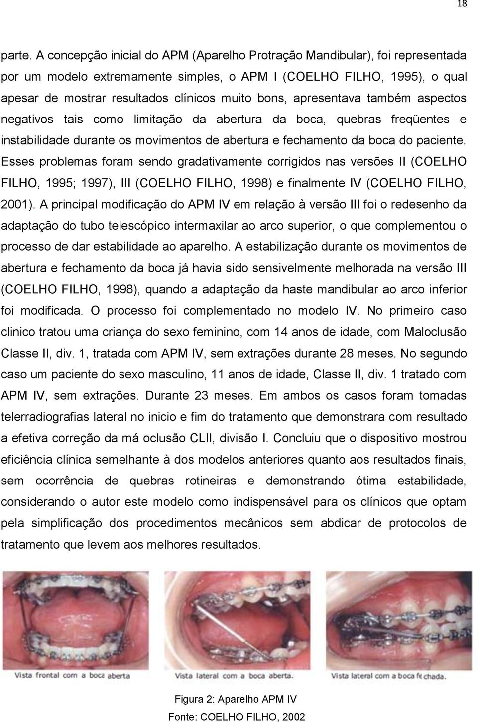 apresentava também aspectos negativos tais como limitação da abertura da boca, quebras freqüentes e instabilidade durante os movimentos de abertura e fechamento da boca do paciente.