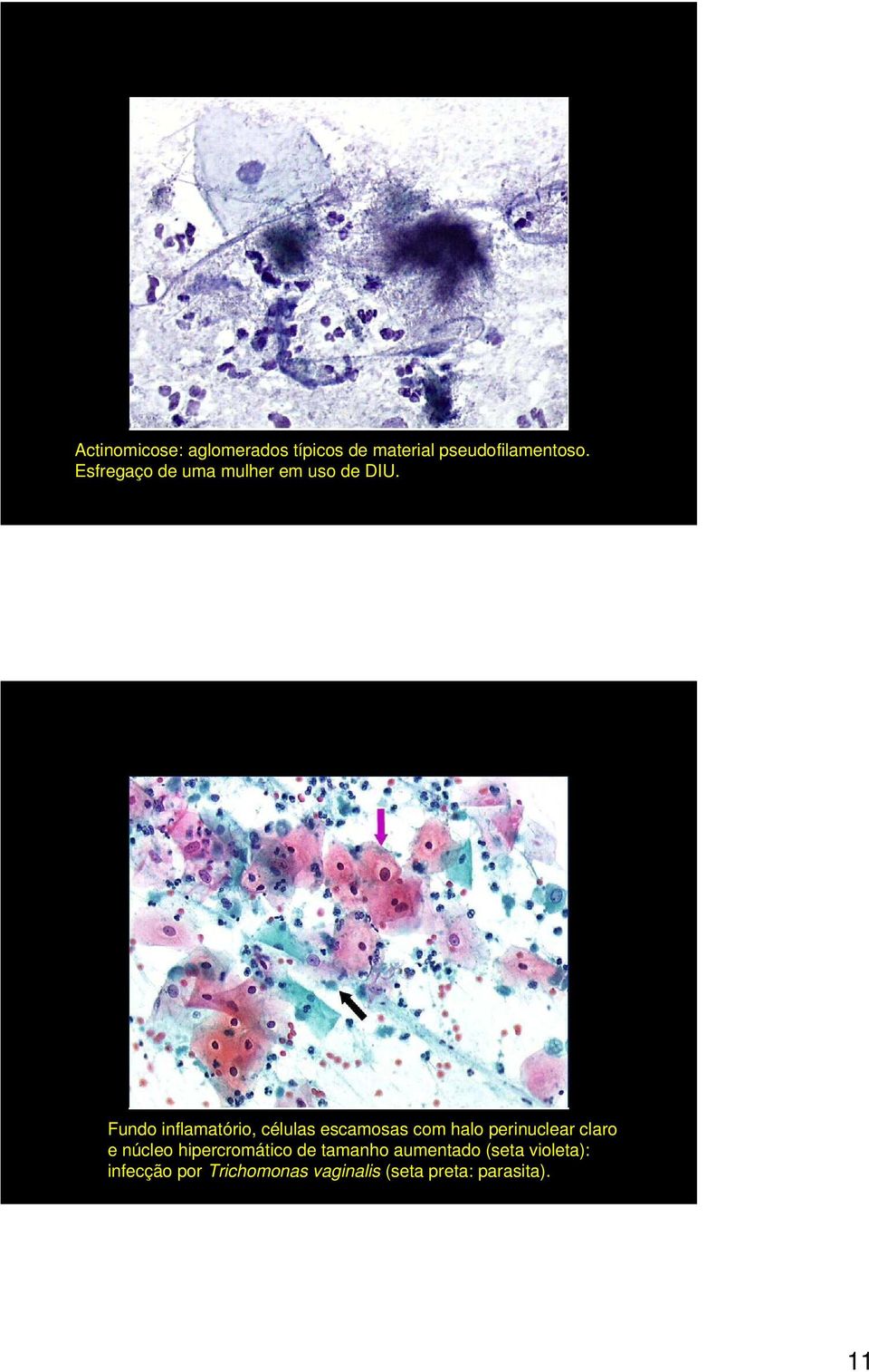 Fundo inflamatório, células escamosas com halo perinuclear claro e