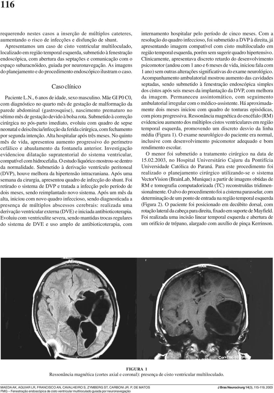 subaracnóideo, guiada por neuronavegação. As imagens do planejamento e do procedimento endoscópico ilustram o caso. Caso clínico Paciente L.N., 6 anos de idade, sexo masculino.