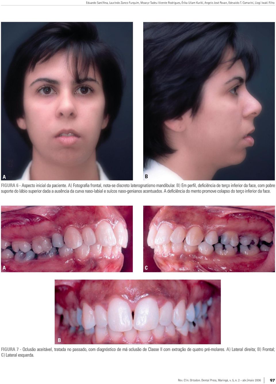 ) Em perfil, deficiência de terço inferior da face, com pobre suporte do lábio superior dada a ausência da curva naso-labial e sulcos naso-genianos acentuados.