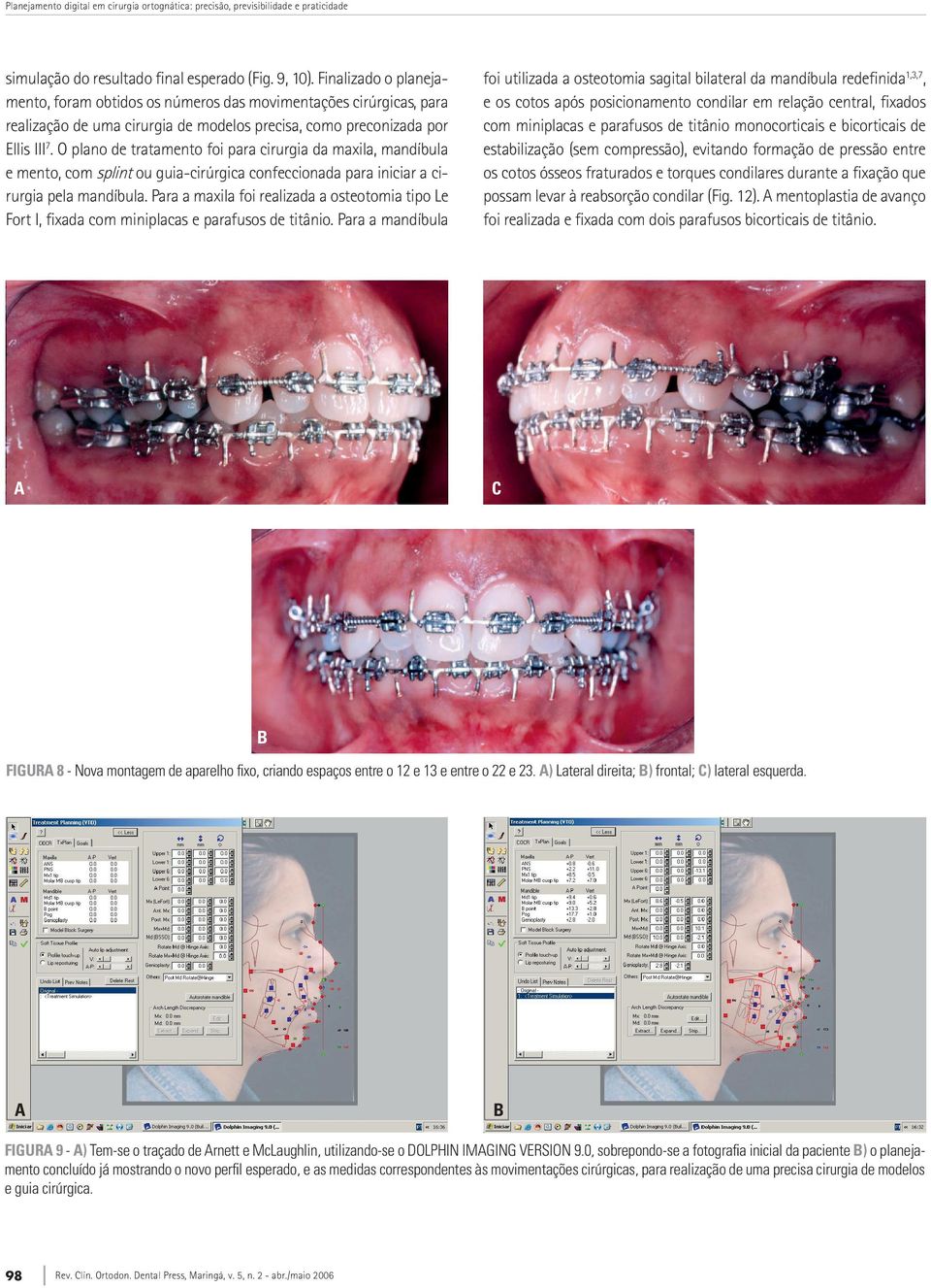 O plano de tratamento foi para cirurgia da maxila, mandíbula e mento, com splint ou guia-cirúrgica confeccionada para iniciar a cirurgia pela mandíbula.