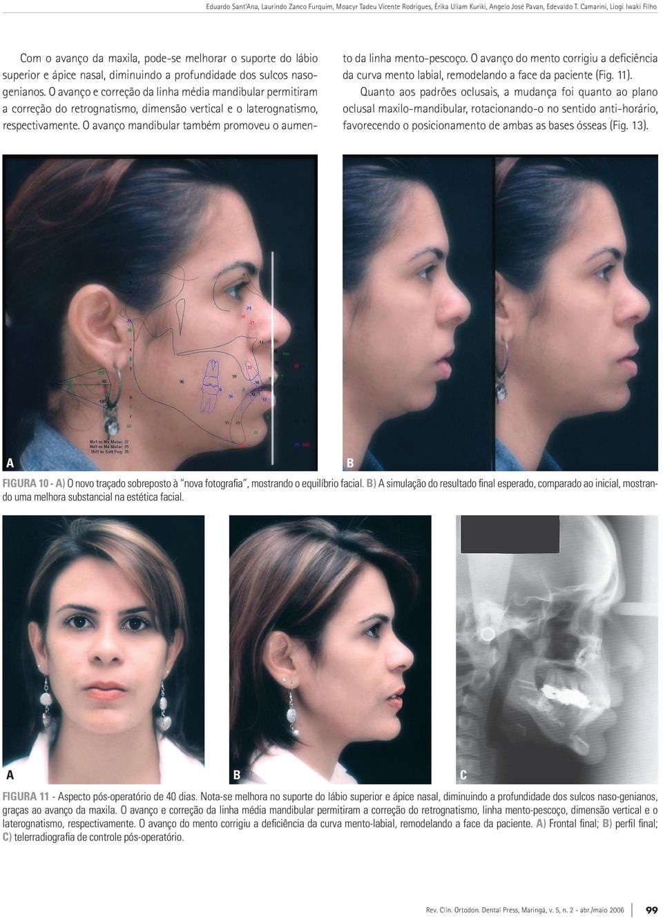 O avanço e correção da linha média mandibular permitiram a correção do retrognatismo, dimensão vertical e o laterognatismo, respectivamente.