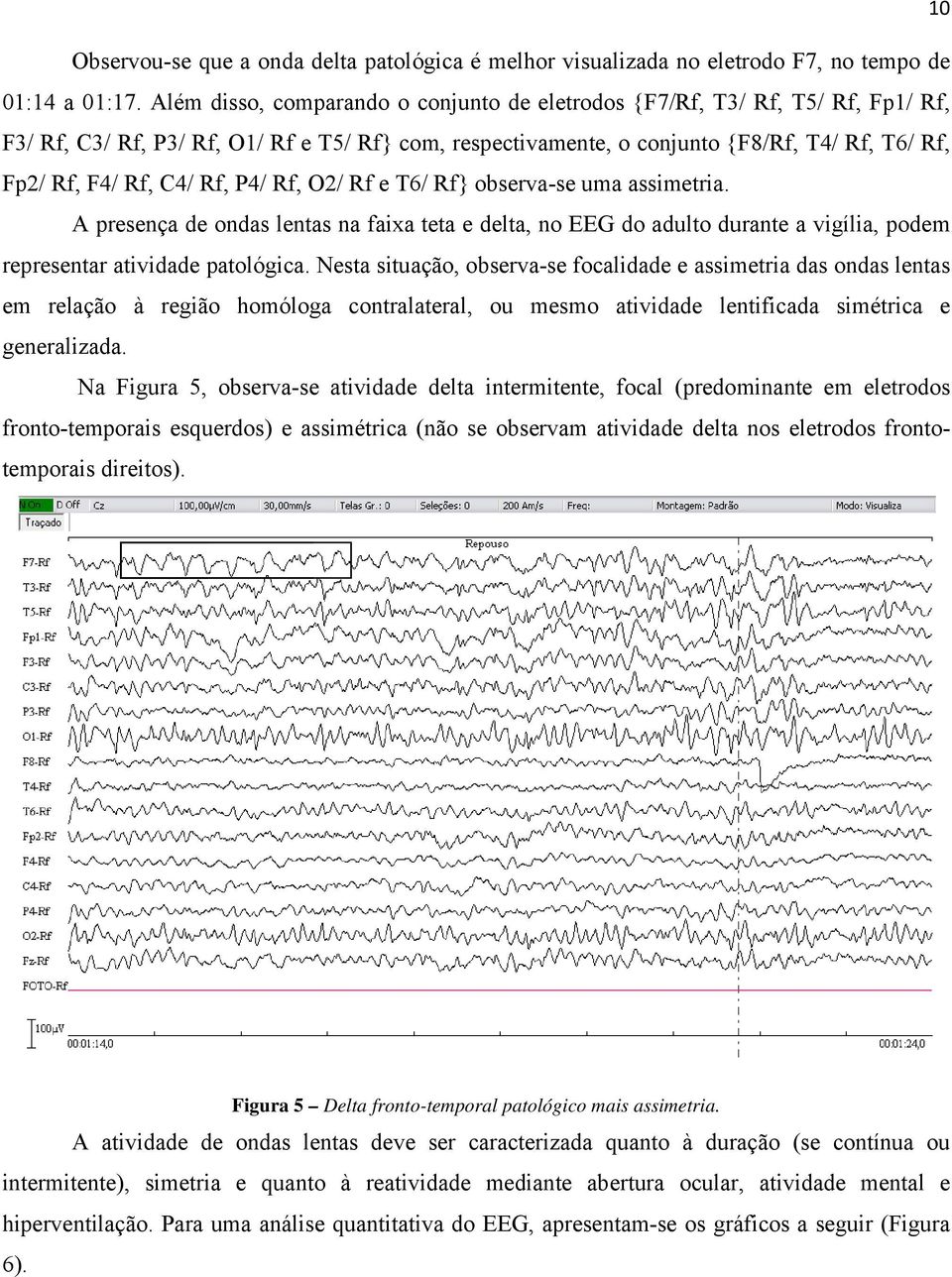 Rf, P4/ Rf, O/ Rf e T6/ Rf} observa-se uma assimetria. A presença de ondas lentas na faixa teta e delta, no EEG do adulto durante a vigília, podem representarr atividade patológica.