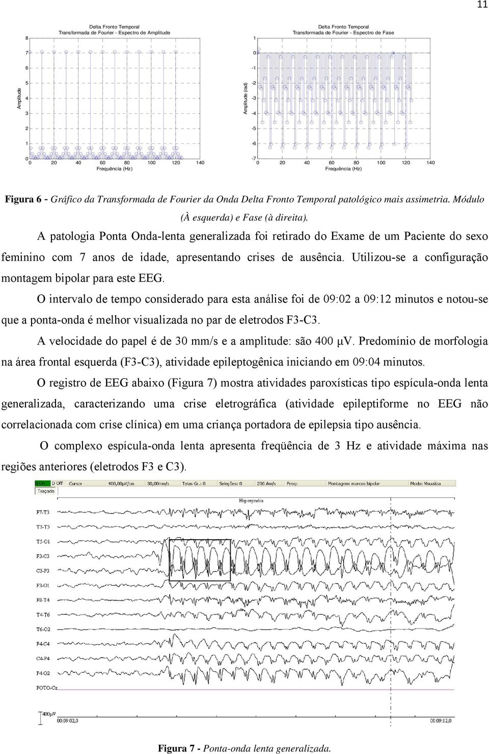 A patologia Ponta Onda-lenta de idade, apresentando crises de ausência. Utilizou-se a configuraçãoo montagem bipolar para este EEG.