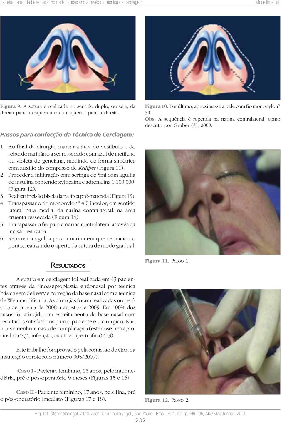 Ao final da cirurgia, marcar a área do vestíbulo e do rebordo narinário a ser ressecado com azul de metileno ou violeta de genciana, medindo de forma simétrica com auxilio do compasso de Kaliper