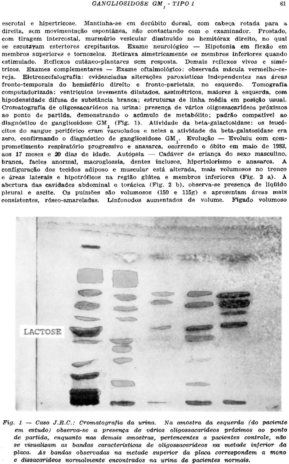 Exame neurológico Hipotonia em flexão em membros superiores e tornozelos. Retirava simetricamente os membros inferiores quando estimulado. Reflexos cutâneo-plantares sem resposta.