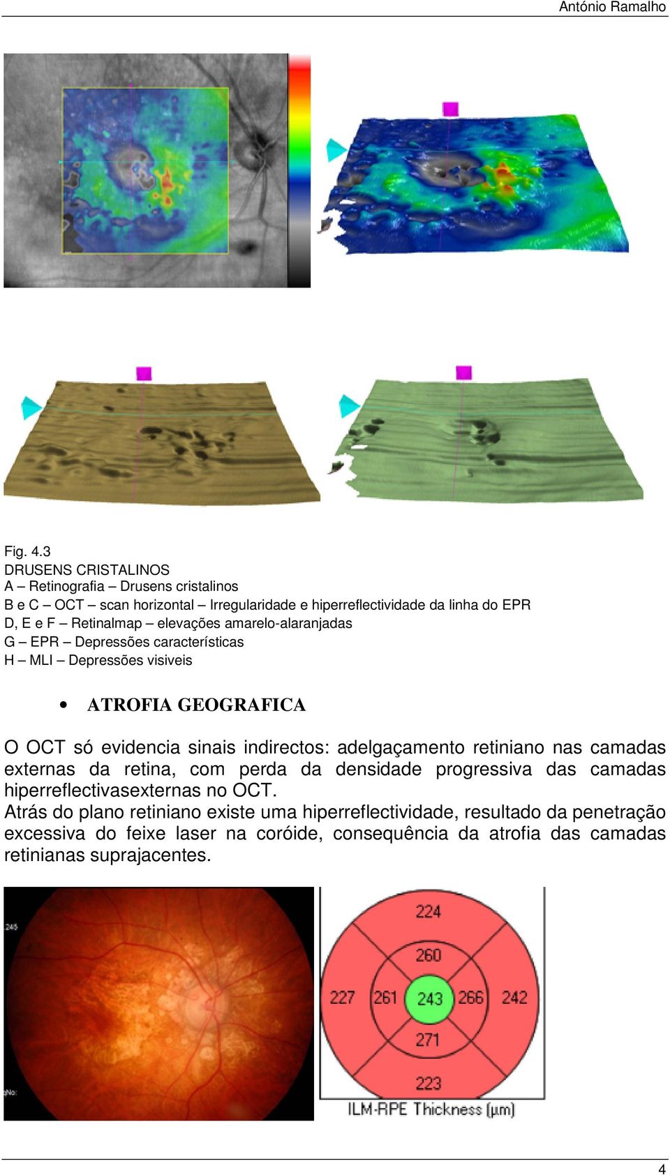 elevações amarelo-alaranjadas G EPR Depressões características H MLI Depressões visiveis ATROFIA GEOGRAFICA O OCT só evidencia sinais indirectos: