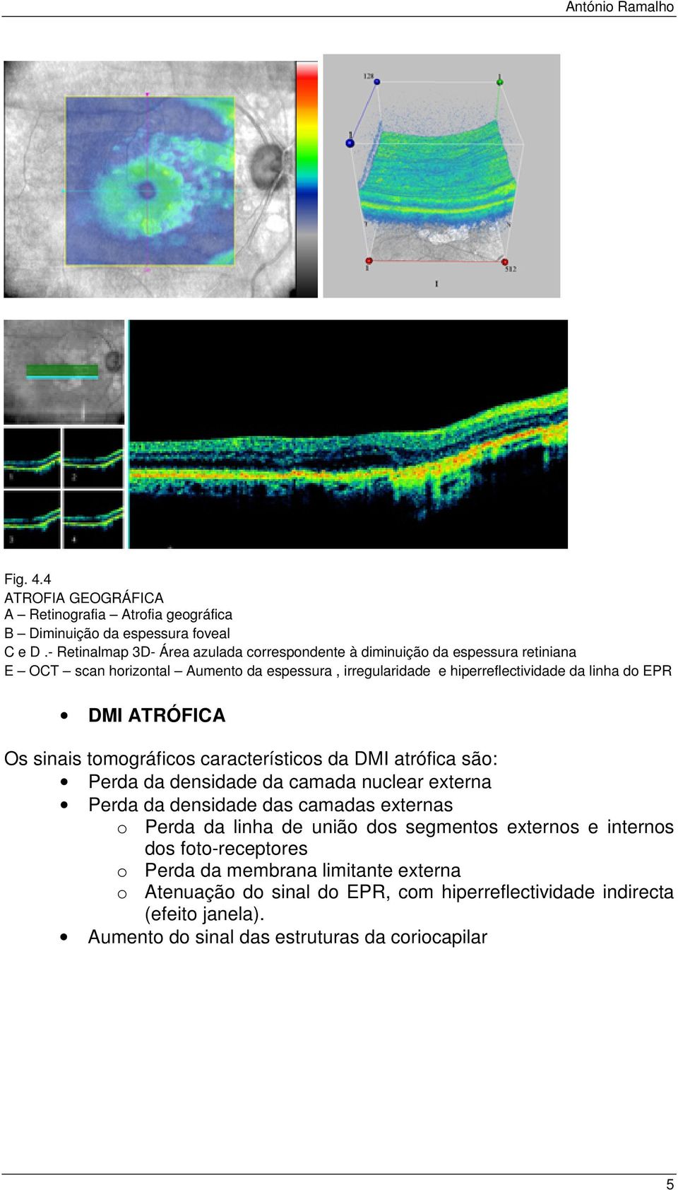 do EPR DMI ATRÓFICA Os sinais tomográficos característicos da DMI atrófica são: Perda da densidade da camada nuclear externa Perda da densidade das camadas externas o