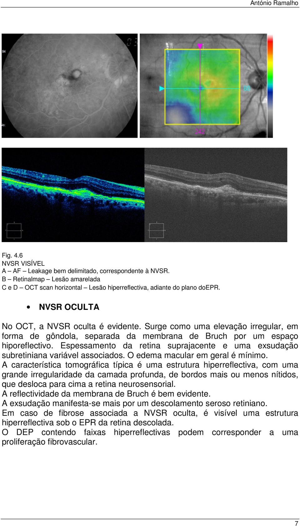 Espessamento da retina suprajacente e uma exsudação subretiniana variável associados. O edema macular em geral é mínimo.