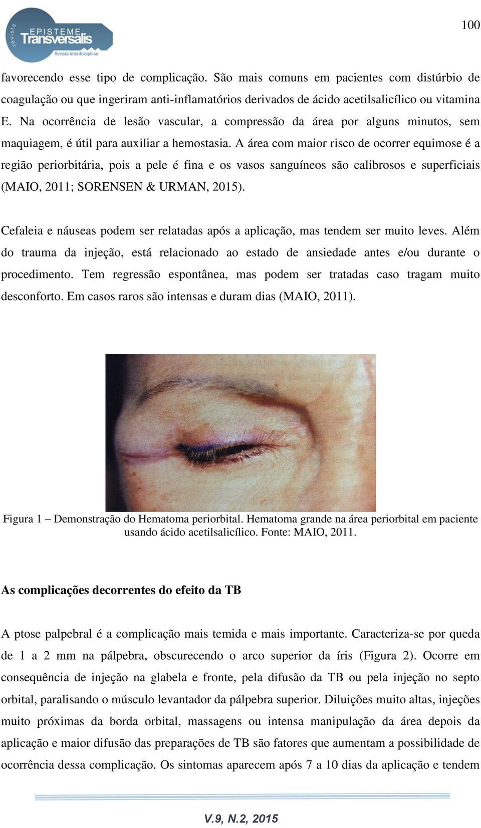 A área com maior risco de ocorrer equimose é a região periorbitária, pois a pele é fina e os vasos sanguíneos são calibrosos e superficiais (MAIO, 2011; SORENSEN & URMAN, 2015).