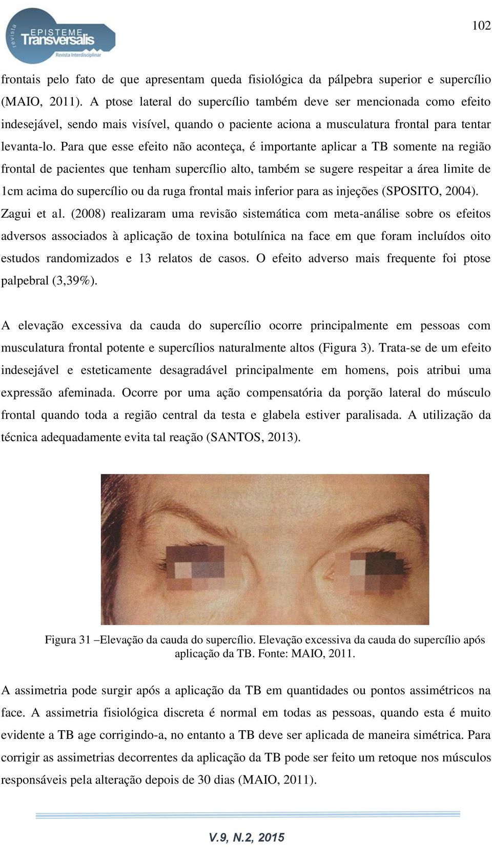 Para que esse efeito não aconteça, é importante aplicar a TB somente na região frontal de pacientes que tenham supercílio alto, também se sugere respeitar a área limite de 1cm acima do supercílio ou