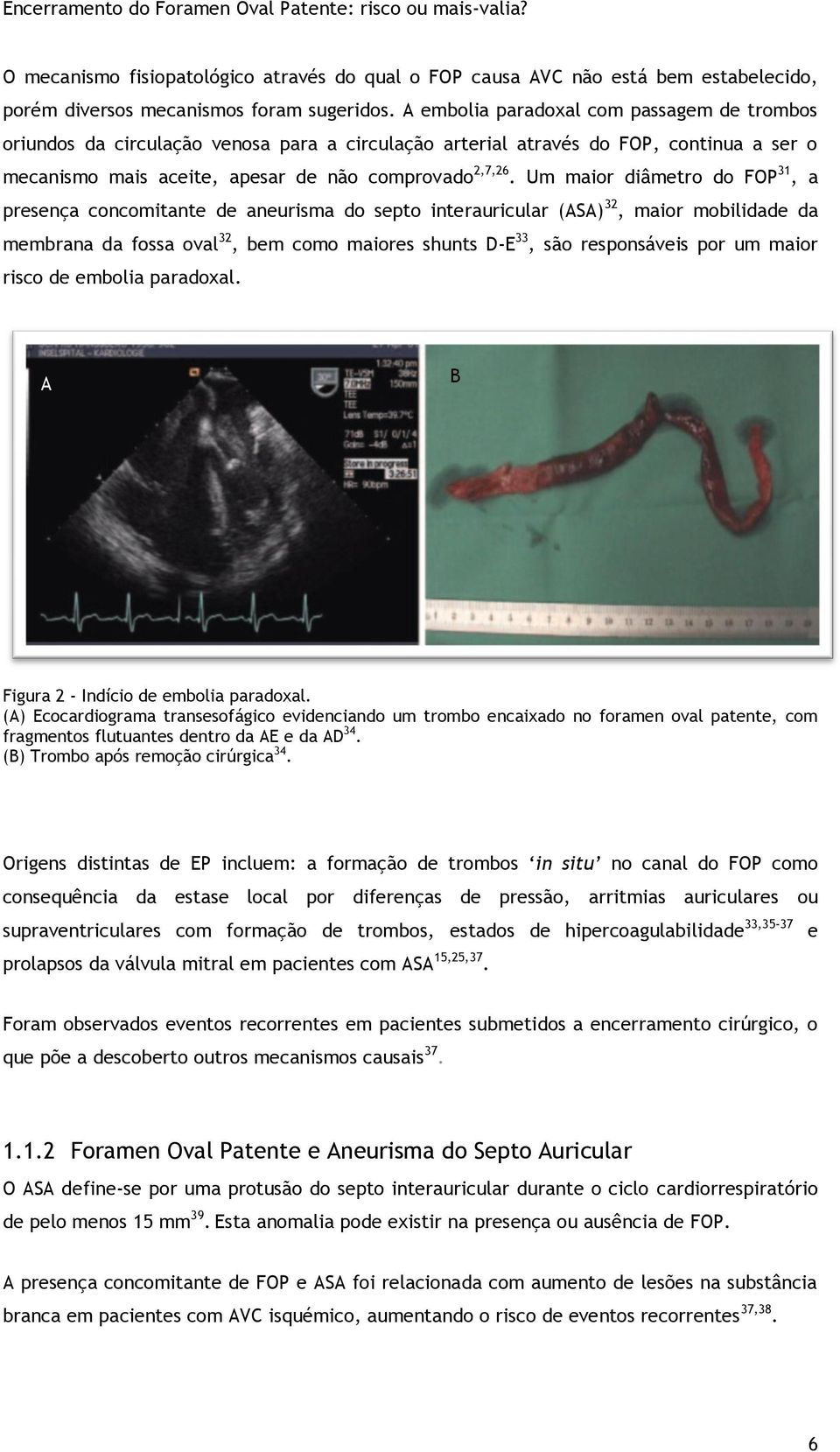 Um maior diâmetro do FOP 31, a presença concomitante de aneurisma do septo interauricular (ASA) 32, maior mobilidade da membrana da fossa oval 32, bem como maiores shunts D-E 33, são responsáveis por