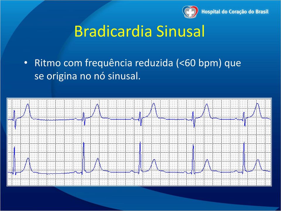 reduzida (<60 bpm) que