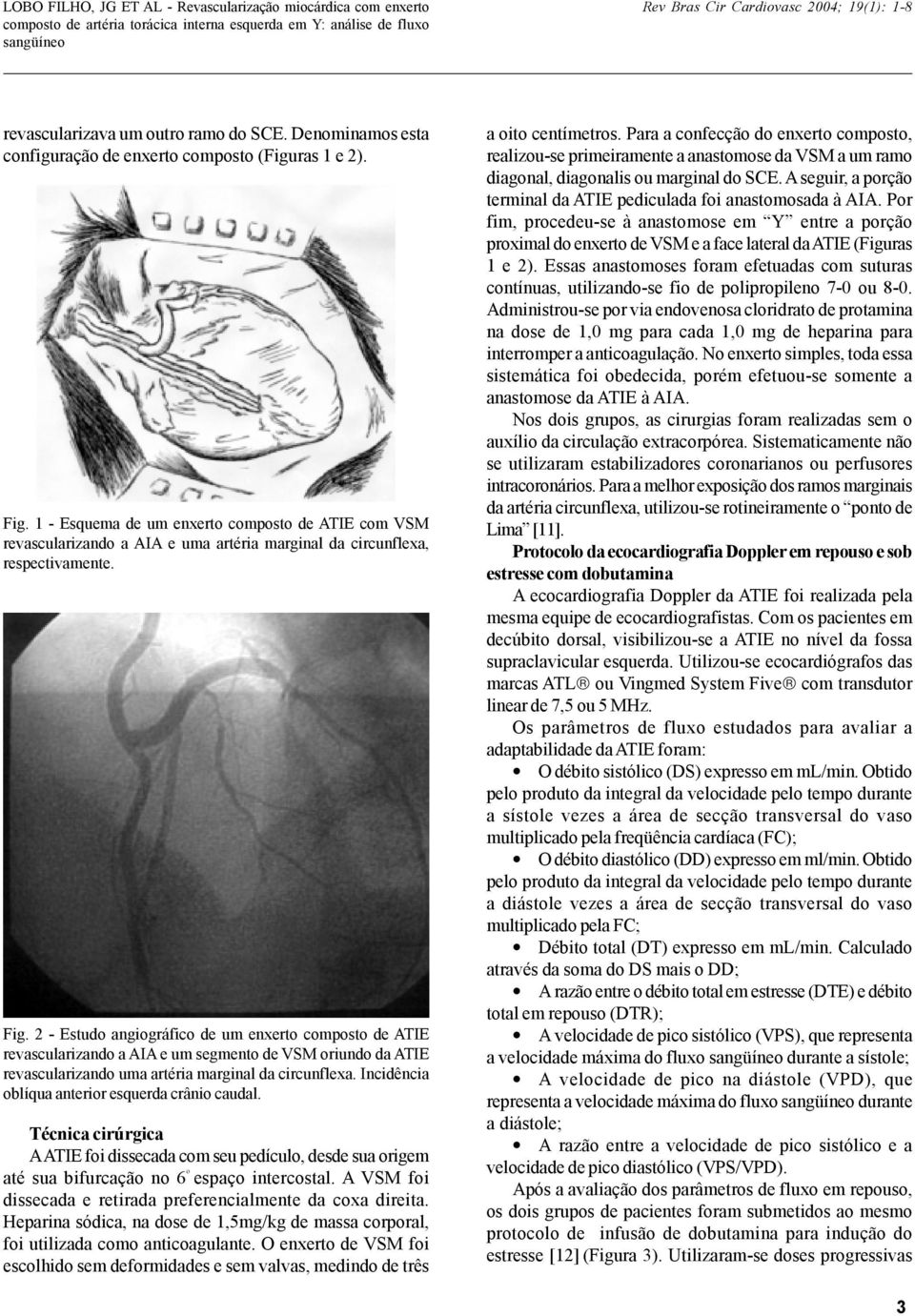 2 - Estudo angiográfico de um enxerto composto de ATIE revascularizando a AIA e um segmento de VSM oriundo da ATIE revascularizando uma artéria marginal da circunflexa.