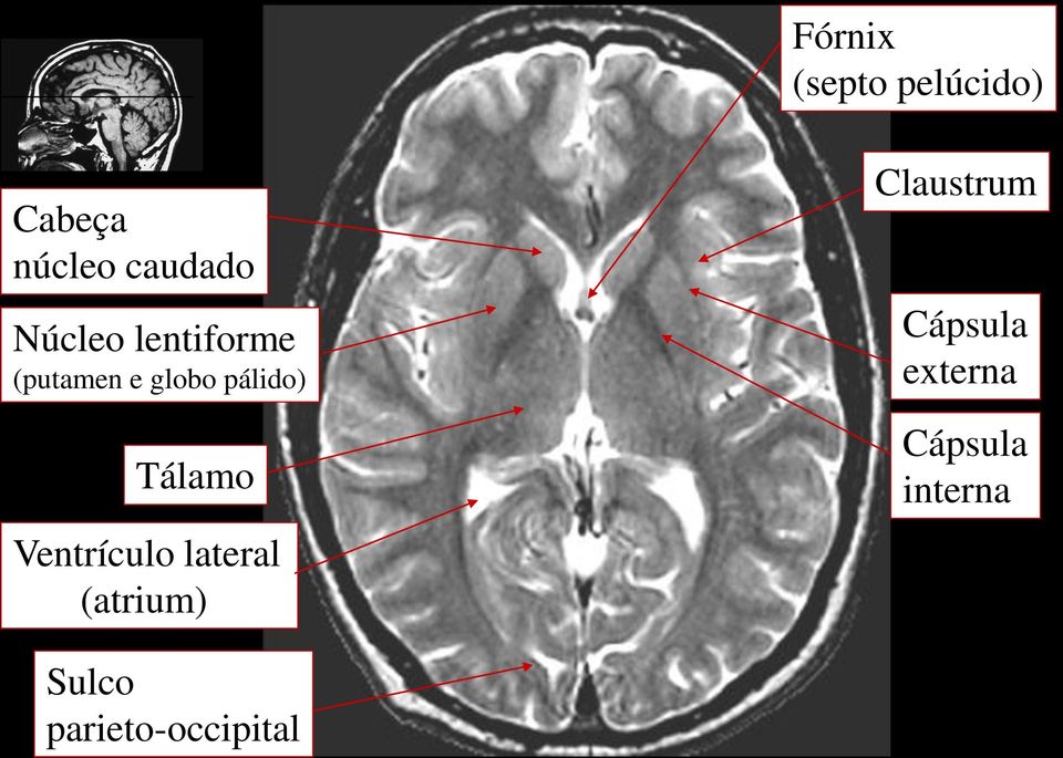 Tálamo Ventrículo lateral (atrium) Claustrum