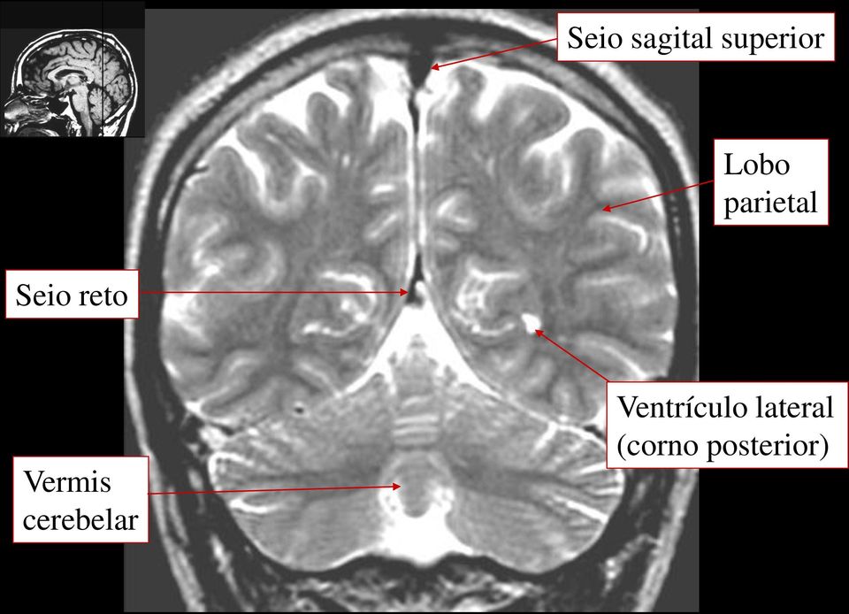 Vermis cerebelar